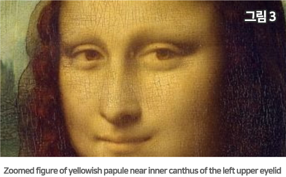 그림3 Zoomed figure of yellowish papule near inner canthus of the left upper eyelid