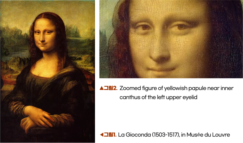 그림1. La Gioconda (1503-1517), in Musee du Louvre 그림2. Zoomed figure of yellowish papule near inner canthus of the left upper eyelid