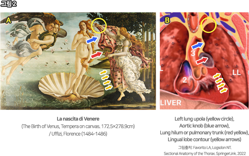 La nascita di Venere 그림과 Left lung upola (yellow circle), Aortic knob (blue arrow), Lung hilum or pulmonary trunk (red yellow), Lingual lobe contour (yellow arrows) 그림