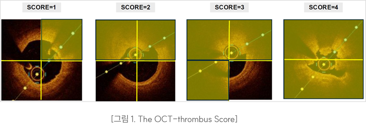 [그림 1. The OCT-thrombus Score]